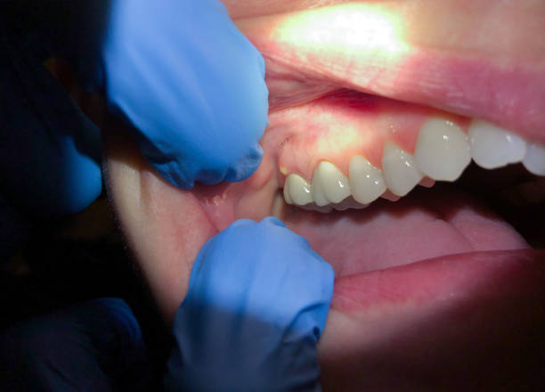 Best Emergency Dental Care for Abscessed Tooth in Detroit Beach, MI