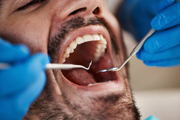 Best Emergency Dental Extractions in Detroit Beach, MI